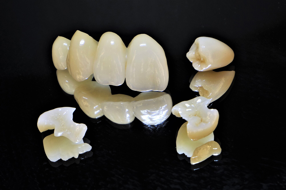 つめ物・かぶせ物について