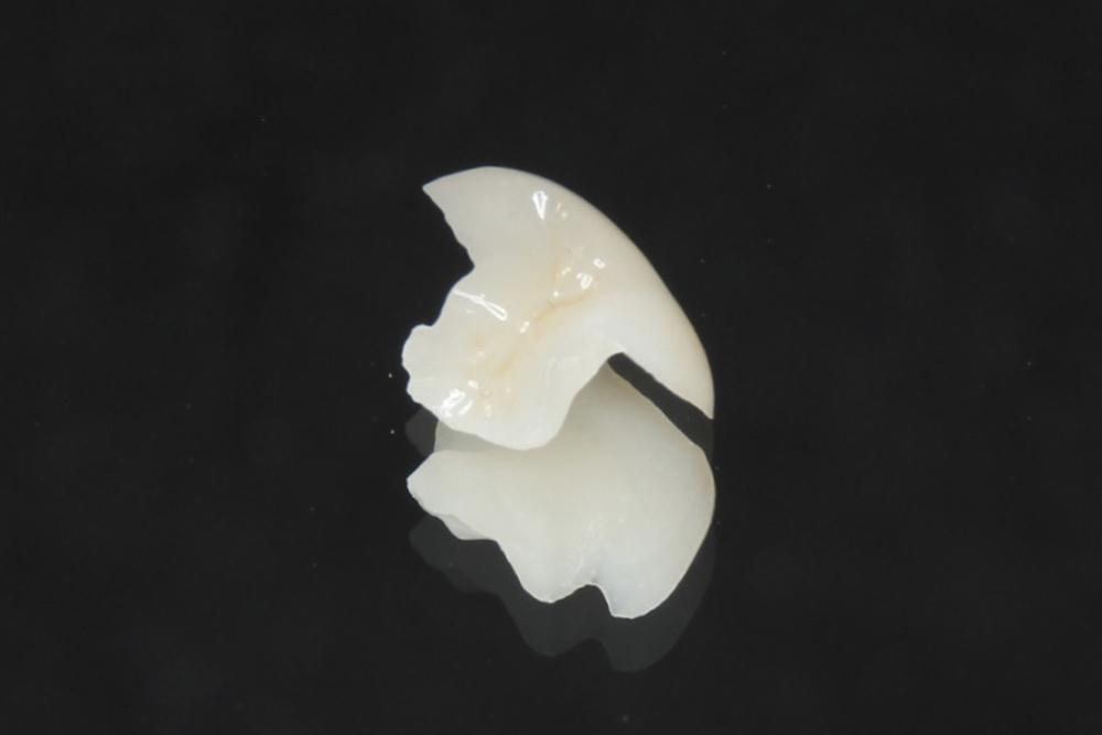 ハイブリッドインレー