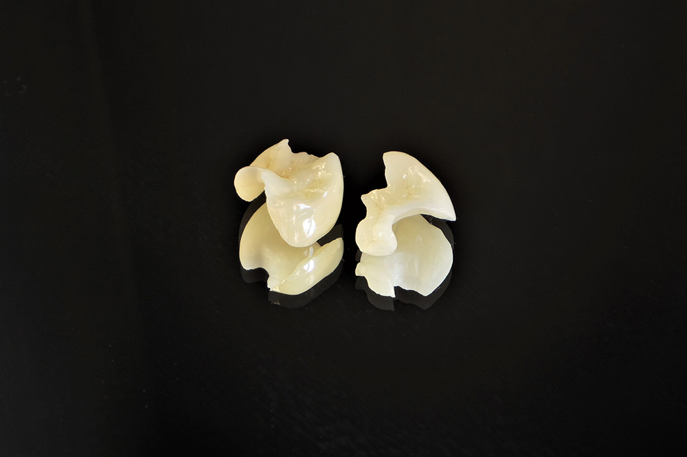 オールセラミッククラウン