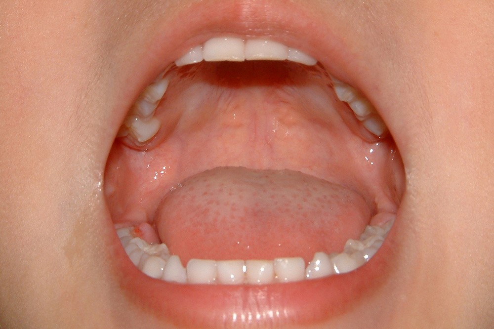 矯正治療について